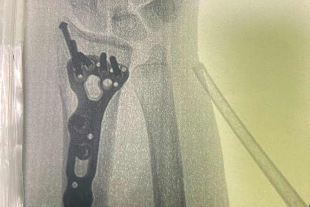 Xray of Lila's double fracture