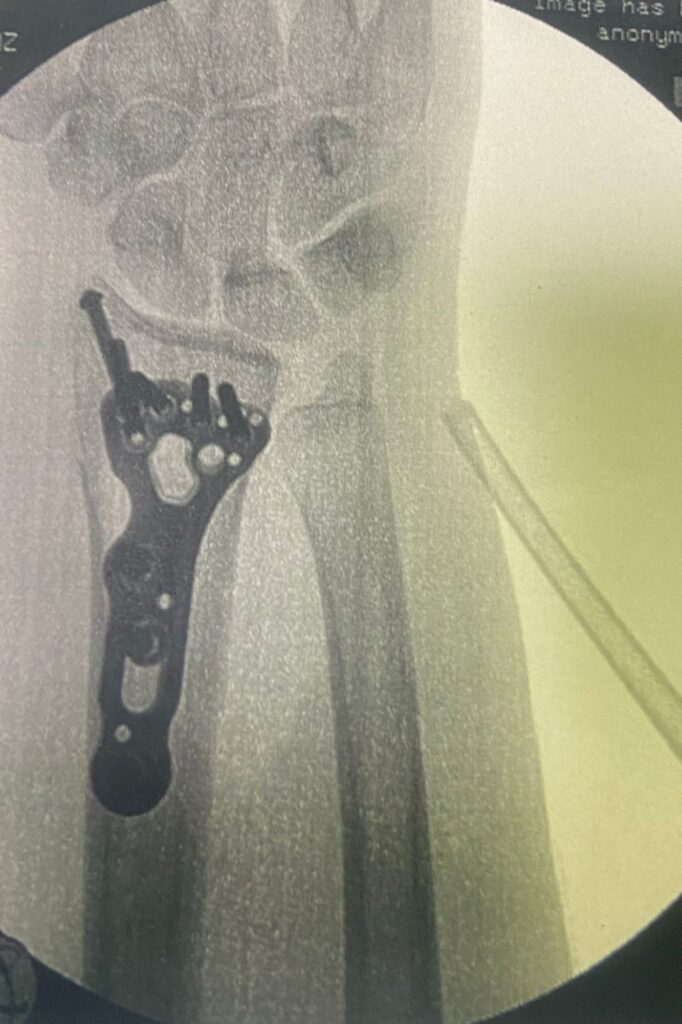 Xray of Lila's double fracture