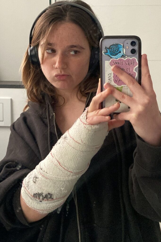 Lila Franco (UCSC) learning to navigate a double wrist fracture while studying abroad in Barcelona